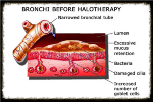 Before Halotherapy